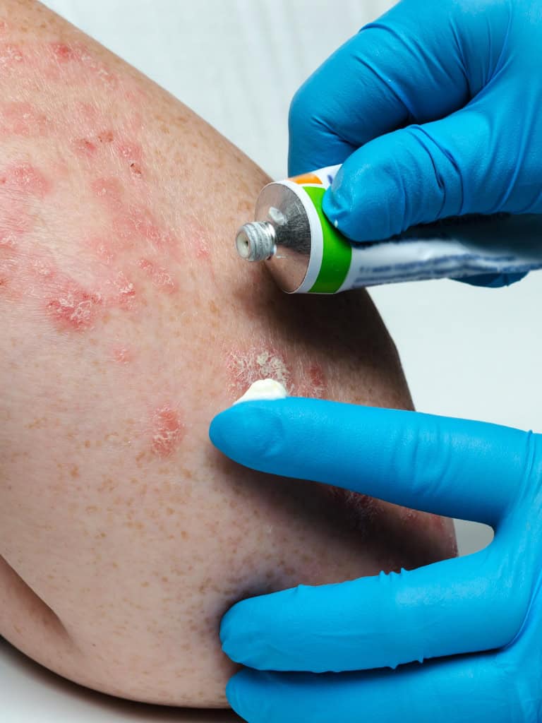 Psoriasis treatment