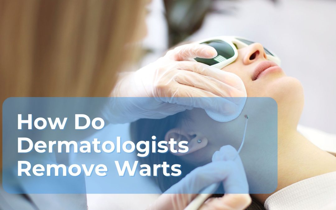 Warts