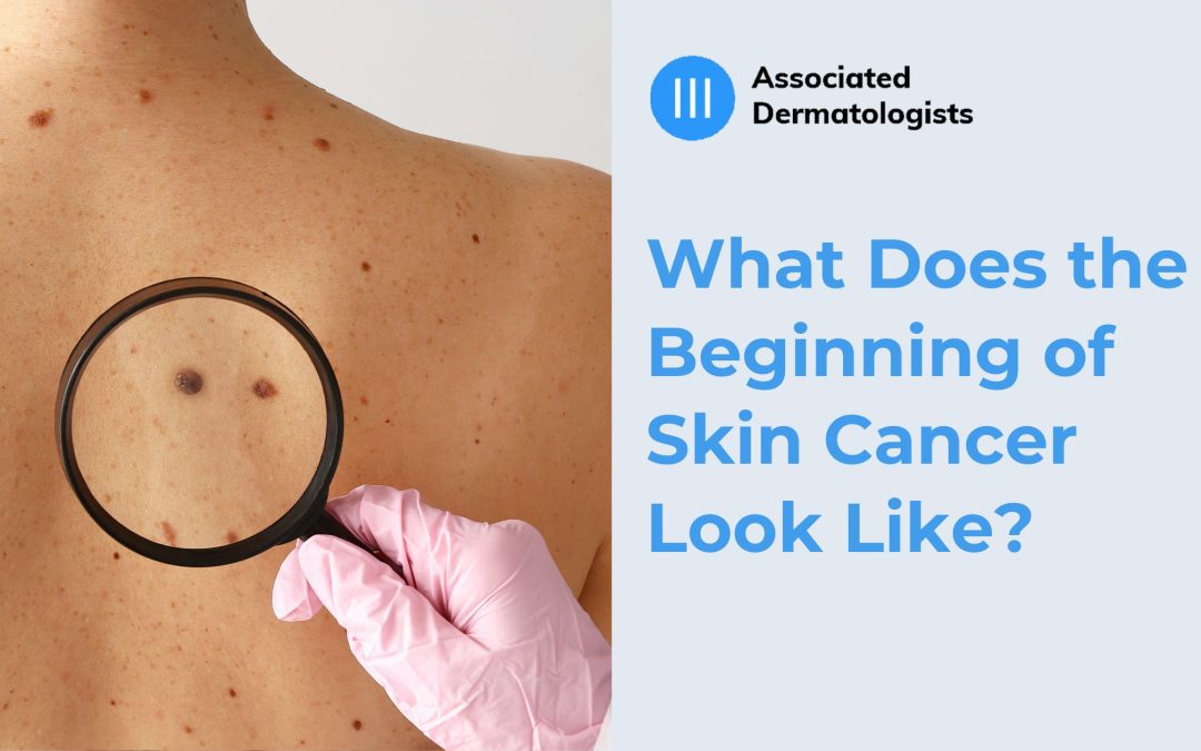 Beginning of Skin Cancer