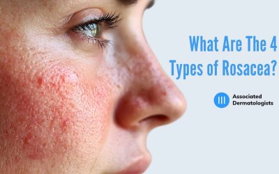 What Are The 4 Types of Rosacea?
