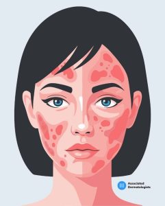 Persistent facial redness