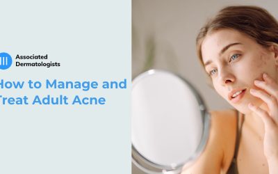 How to Manage and Treat Adult Acne
